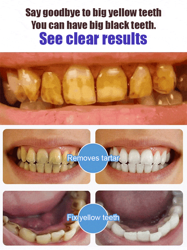 Advanced Intensive Teeth Whitening Toothpaste Buy 1 Get 2 + Free 2 Special Toothbrush)**Combo**